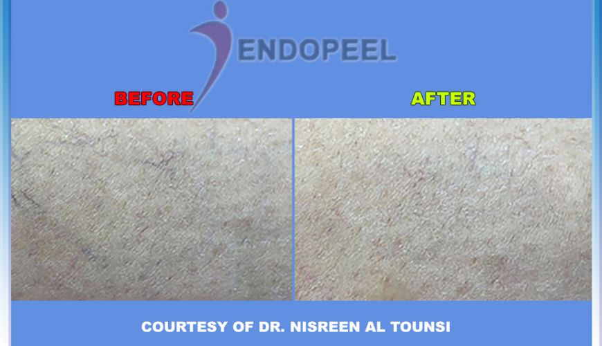 sclerotherapy endopeel