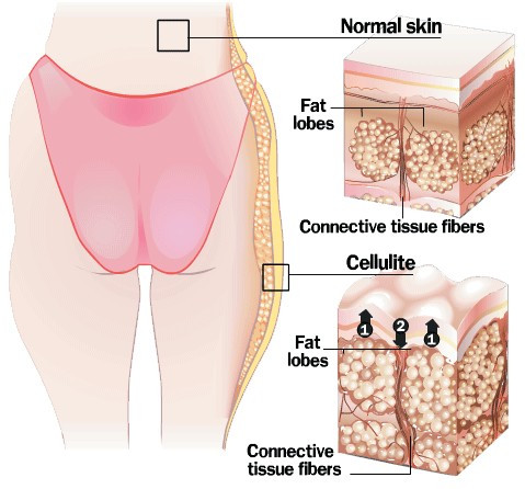 etiology of cellulitis