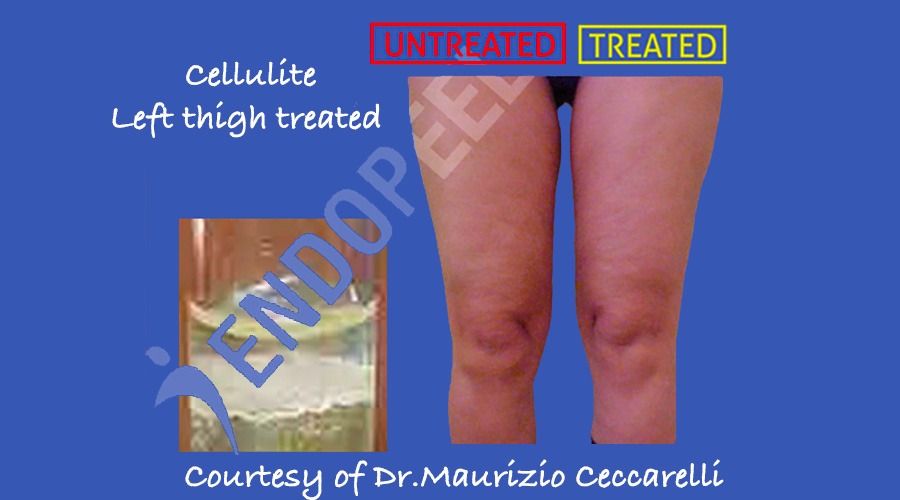 indications/cellulite-ceccarelli-900x500