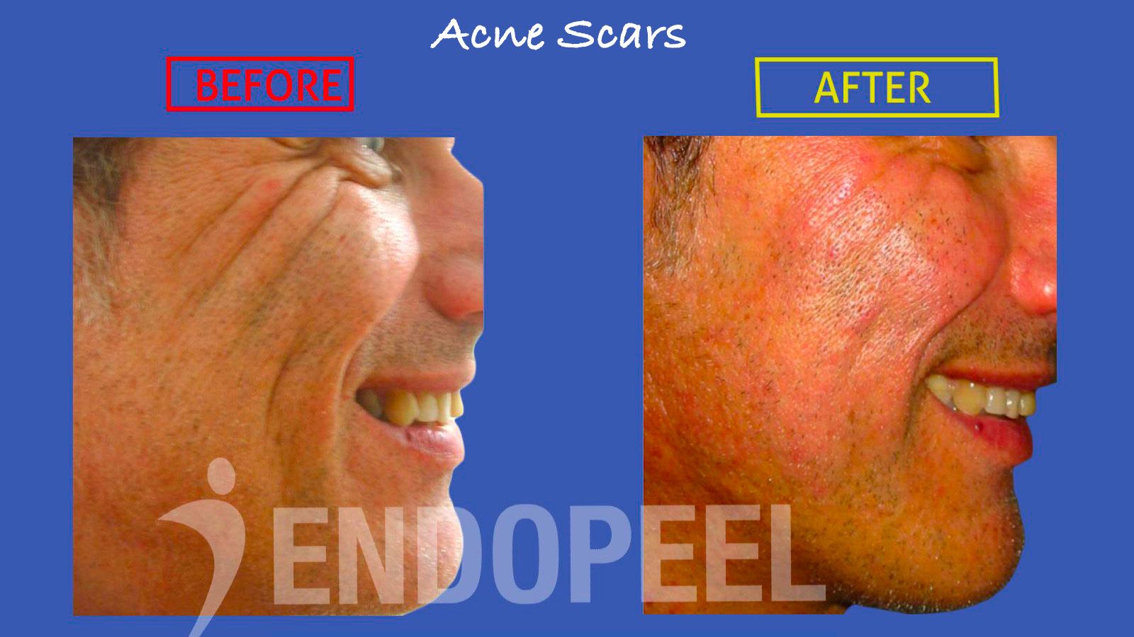 acne-scars