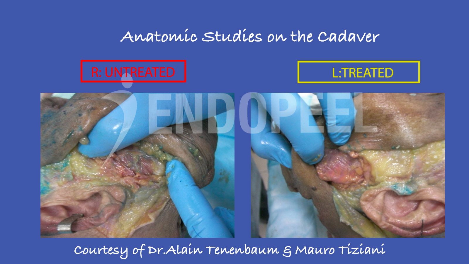 cadavers-studies/anatomic-study-comparison