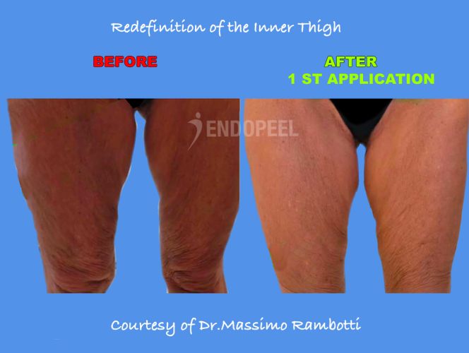 cellulite/rambotti-inner-thighs-redefinition-1200x900.jpg