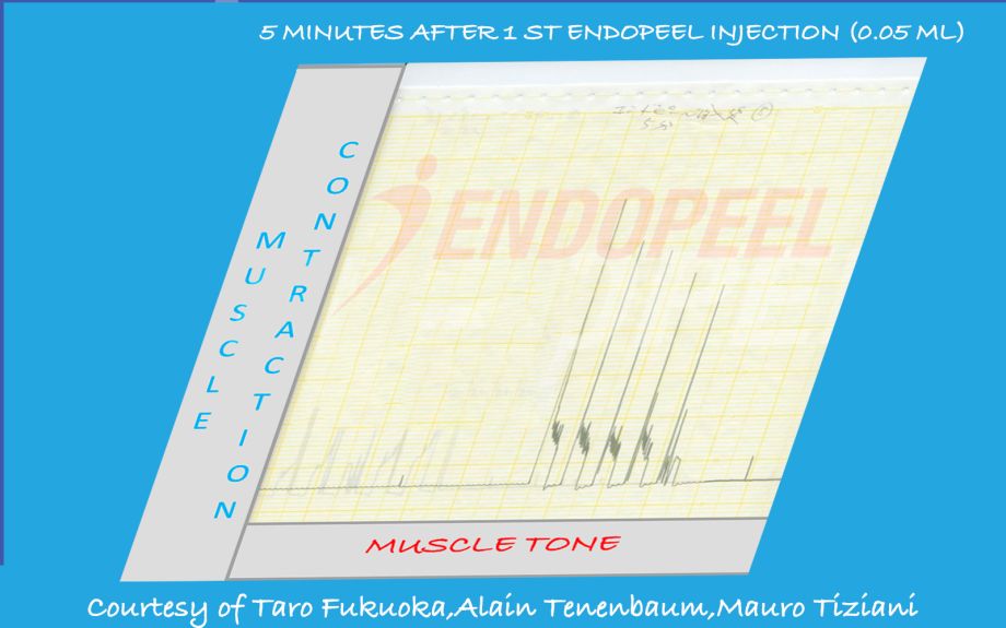 5 minutes after 1 st endopeel injection of 0.05 ml