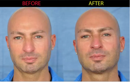 medical rhinoplasty