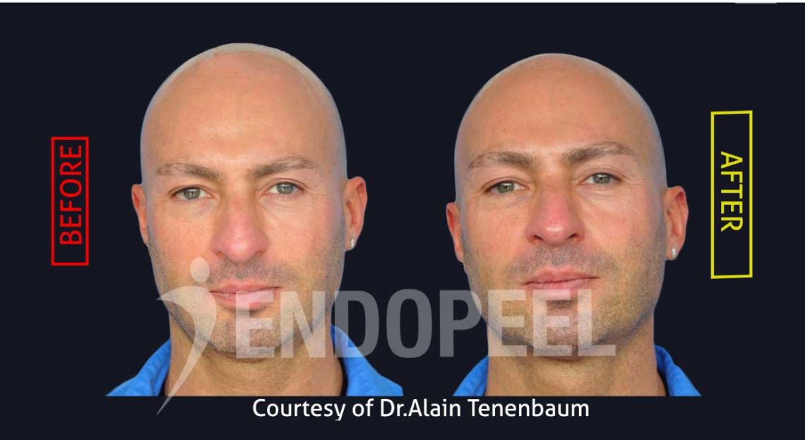 rhinoplasty with endopeel