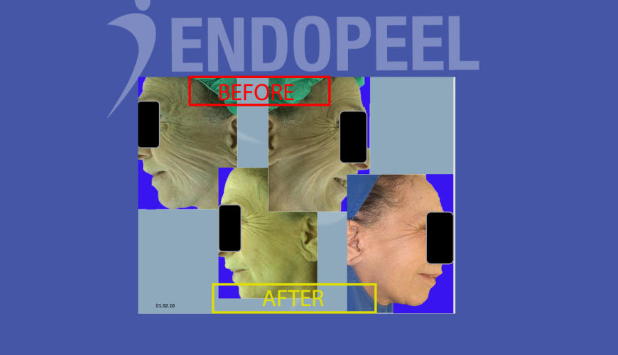 endopeel for aging face