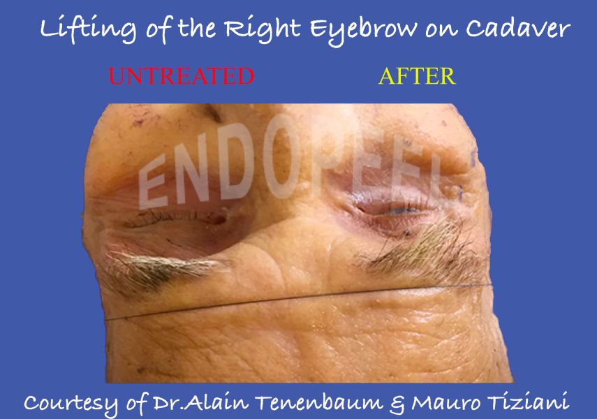 eyebrow-lift on a cadaver with endopeel