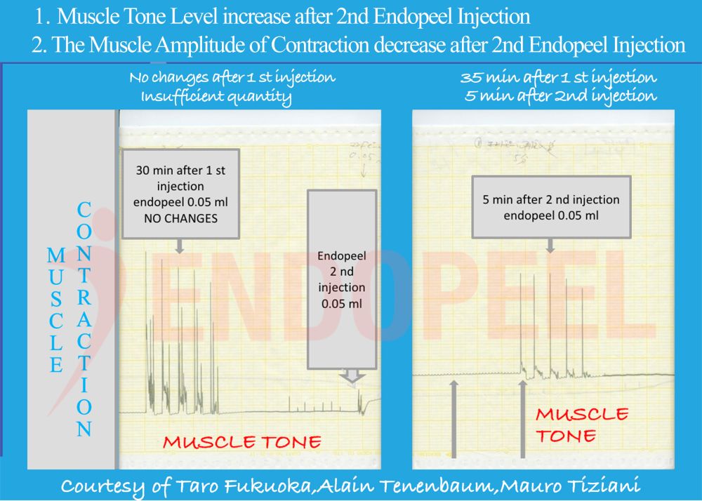 2nd-endopeel-injection