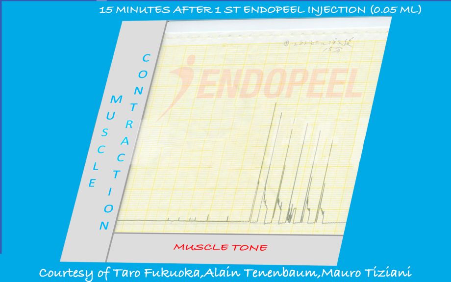 15 min after 1 st endopeel injection of 0.05 ml