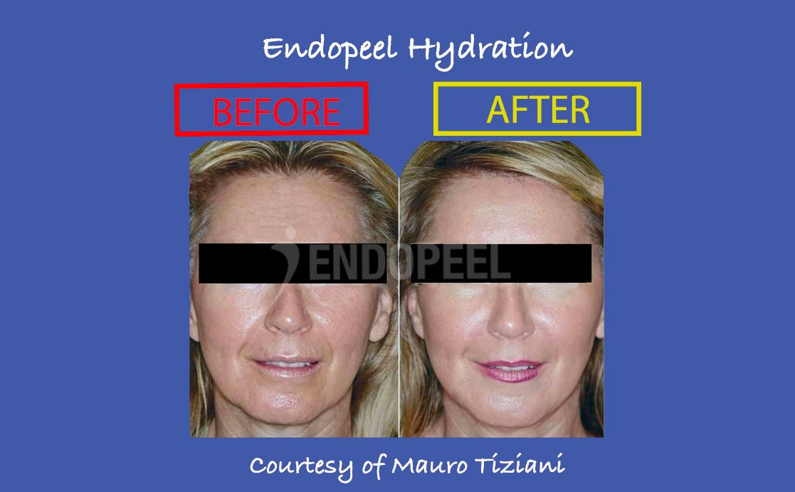 endopeel-hydration