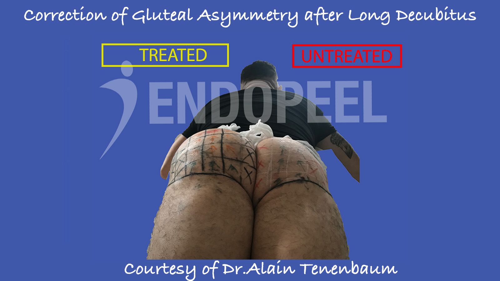 reshaping atrophic butts post trauma with Endopeel